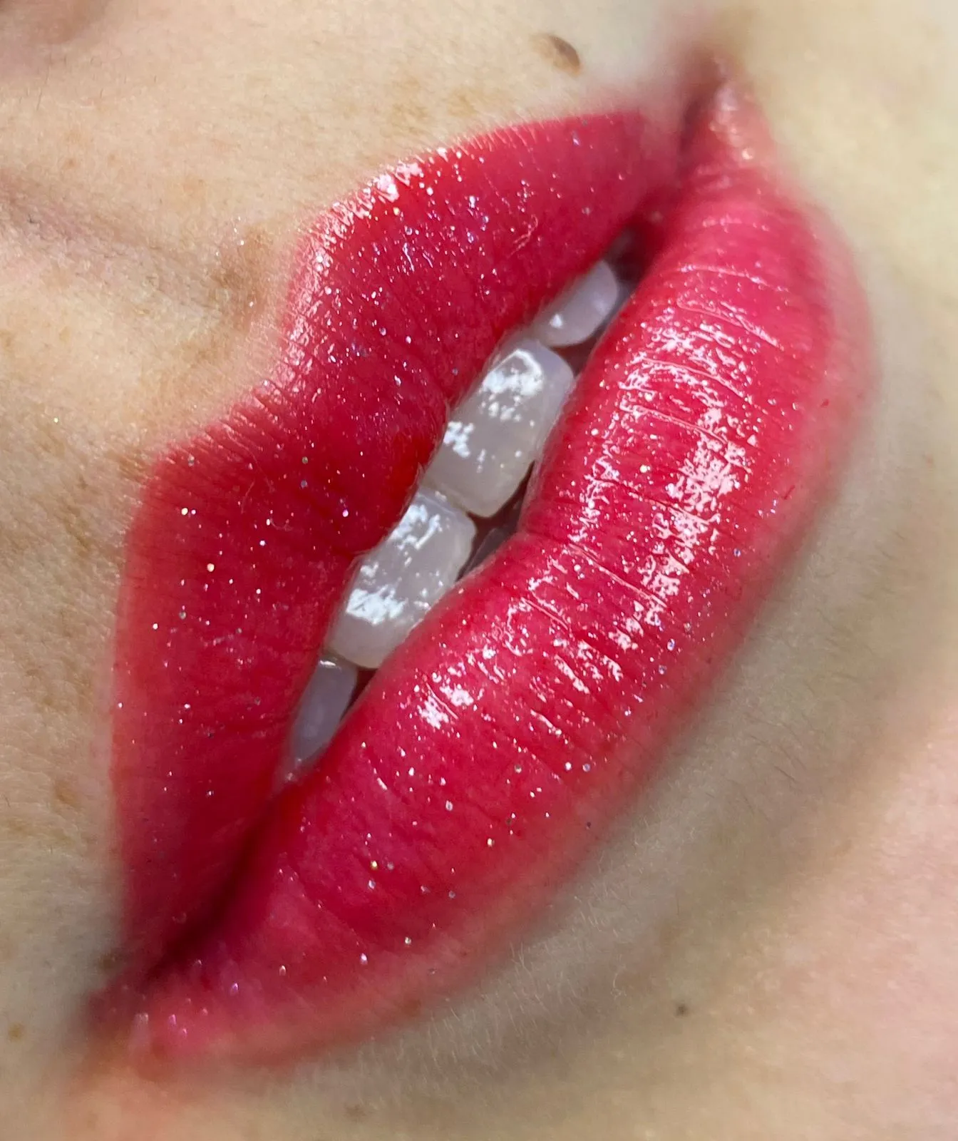 Resultado lábio com SPA labial